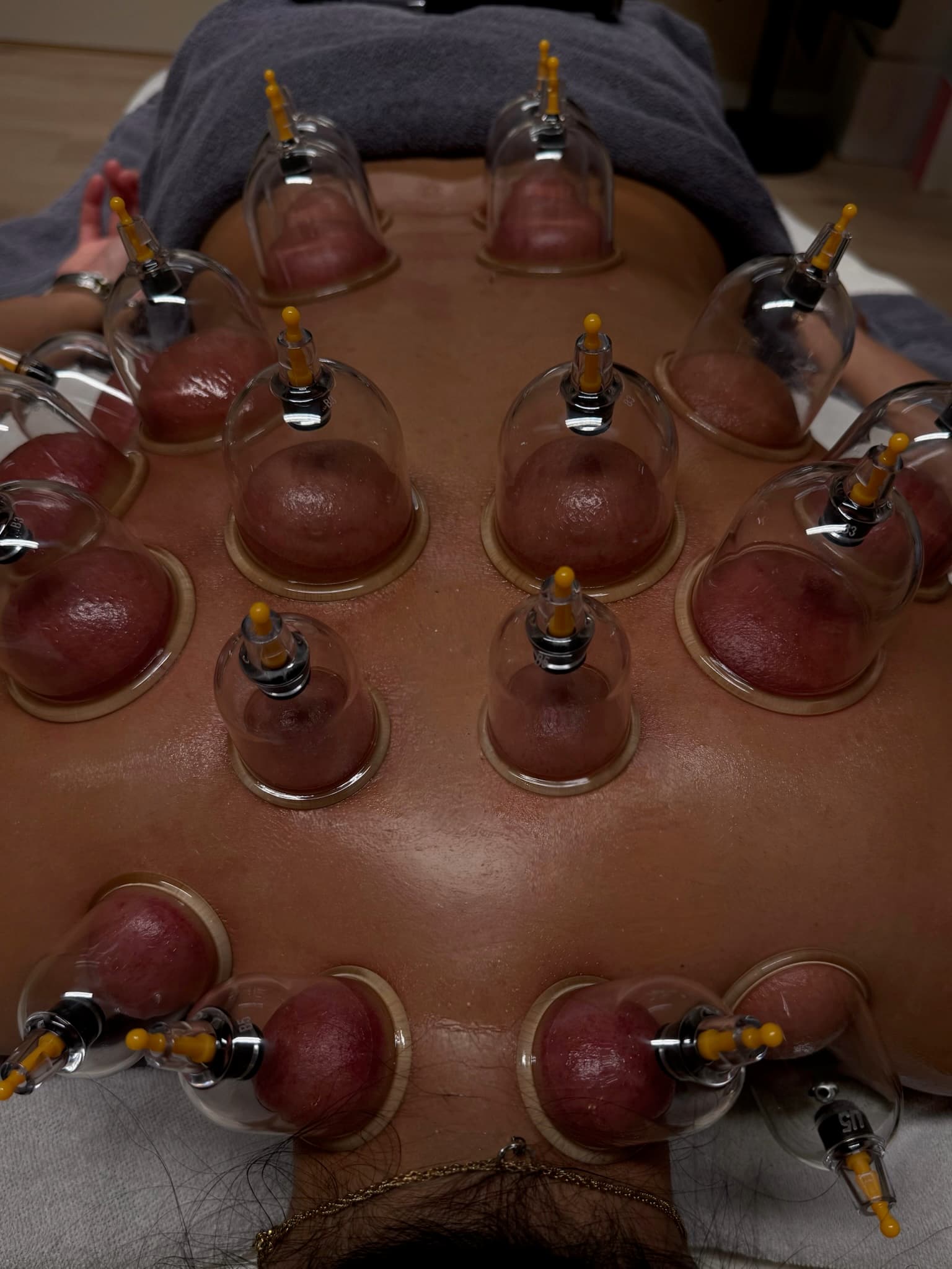 Vakuumkopper placeret under cupping behandling