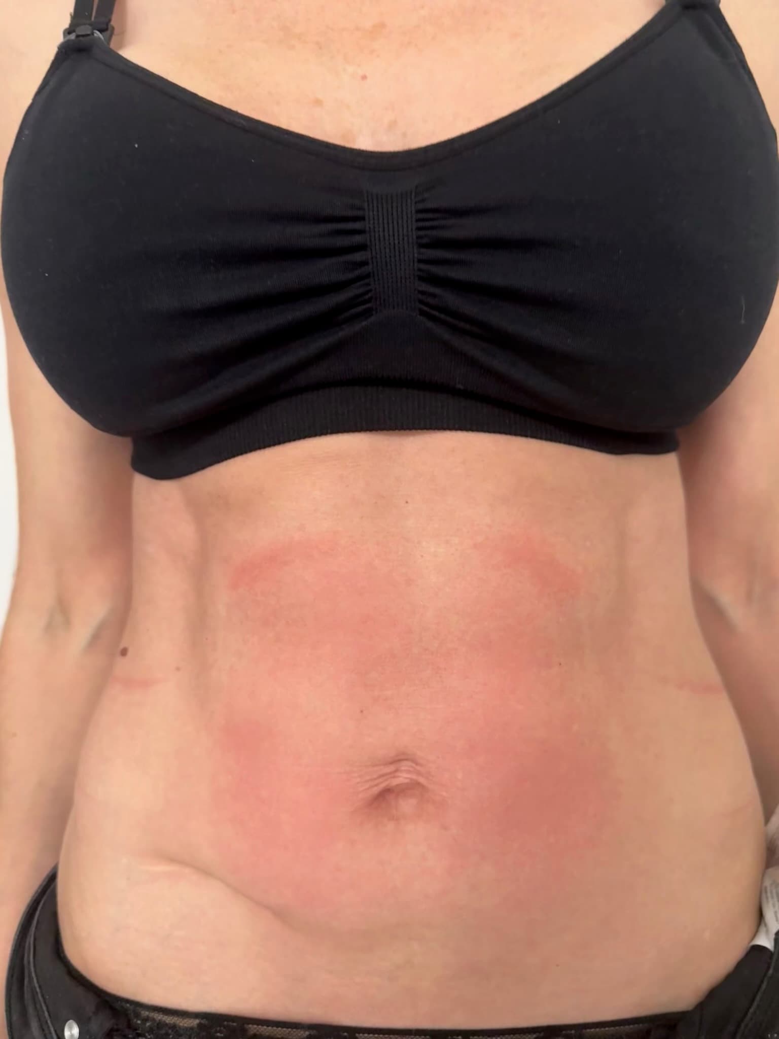 Mave efter EM-Sculpting behandling