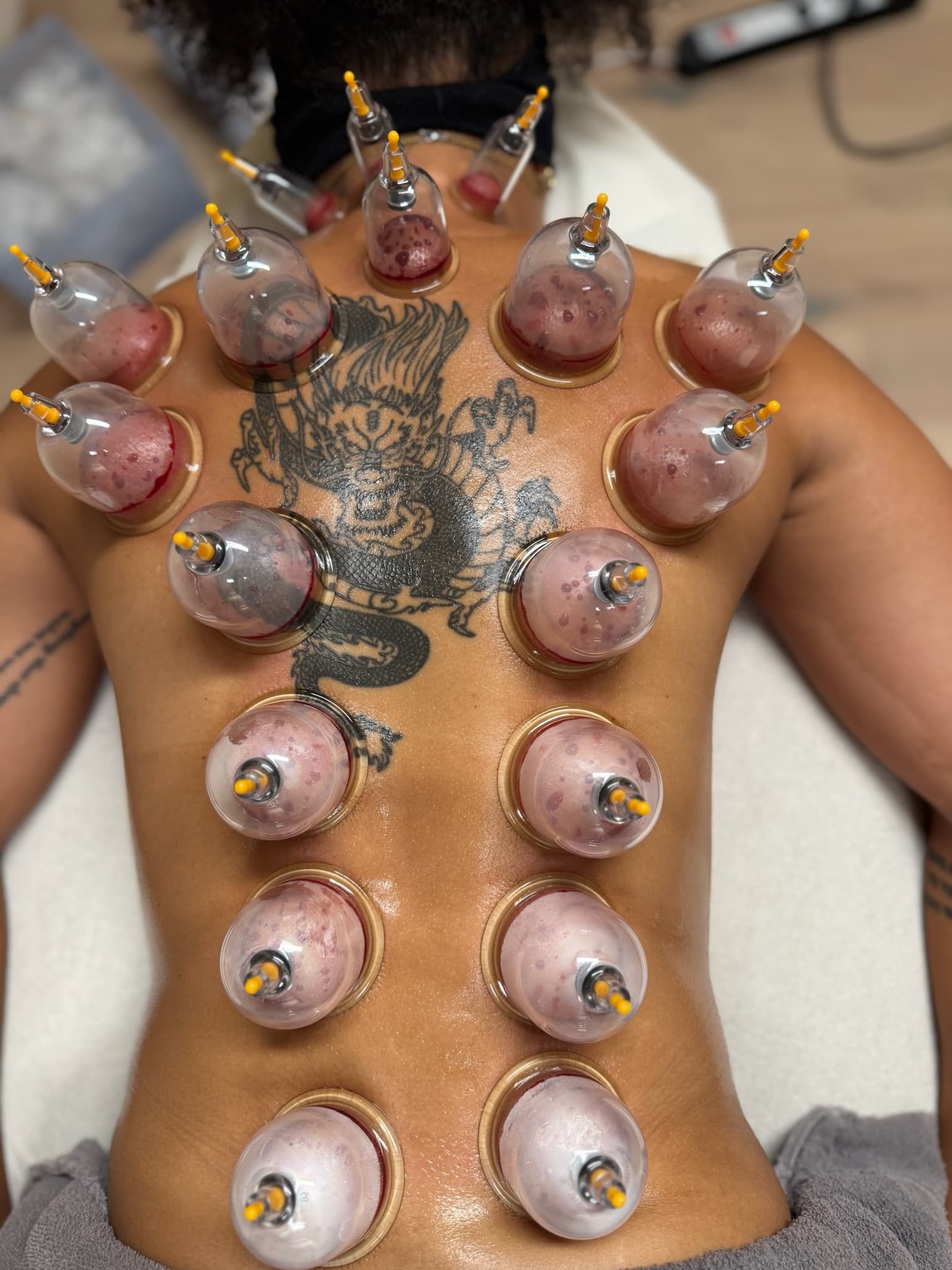 Hijama behandling på hele ryggen med vakuumkopper