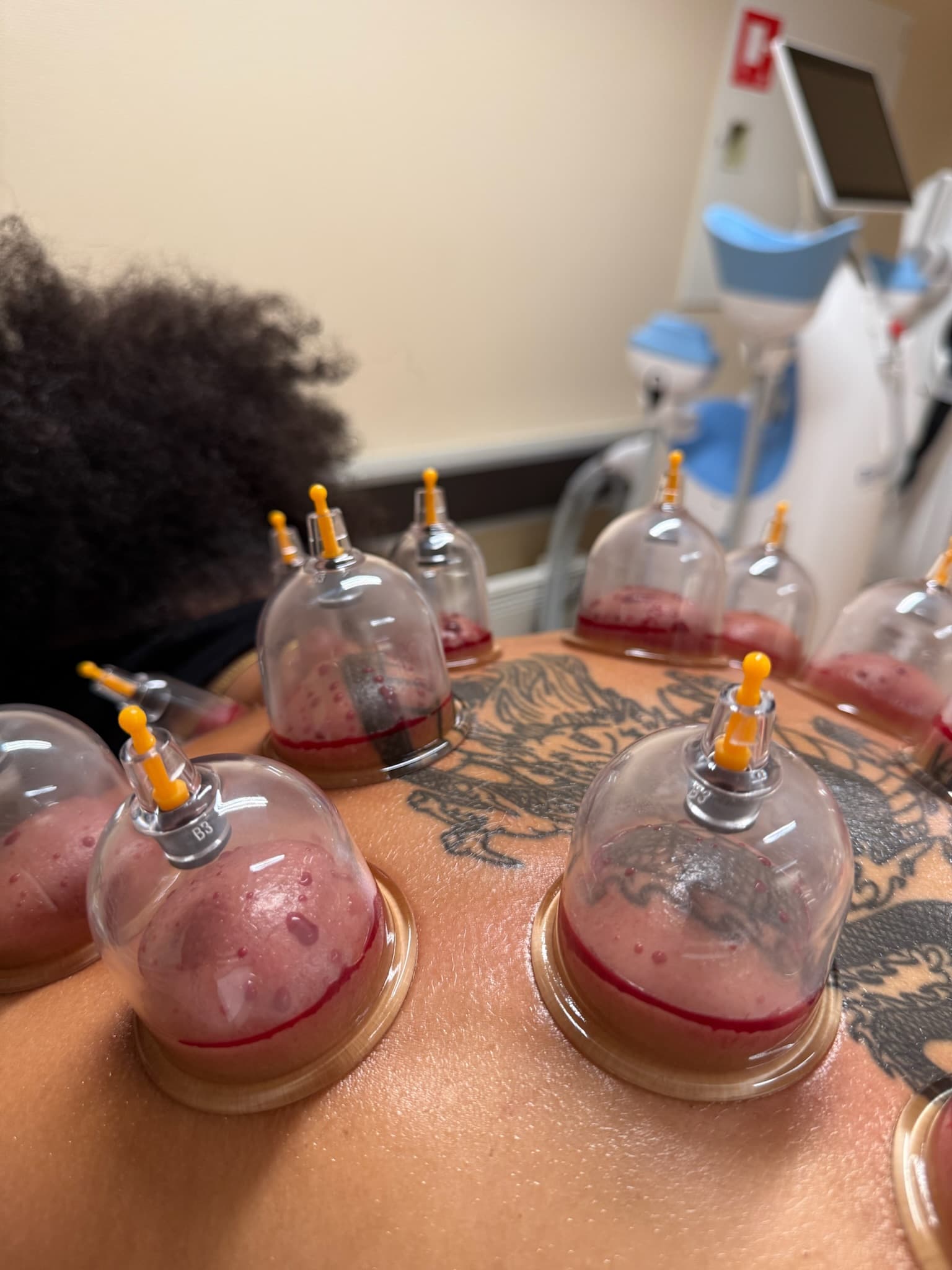 Hijama behandling — nærbillede af vakuumkopper på øvre ryg