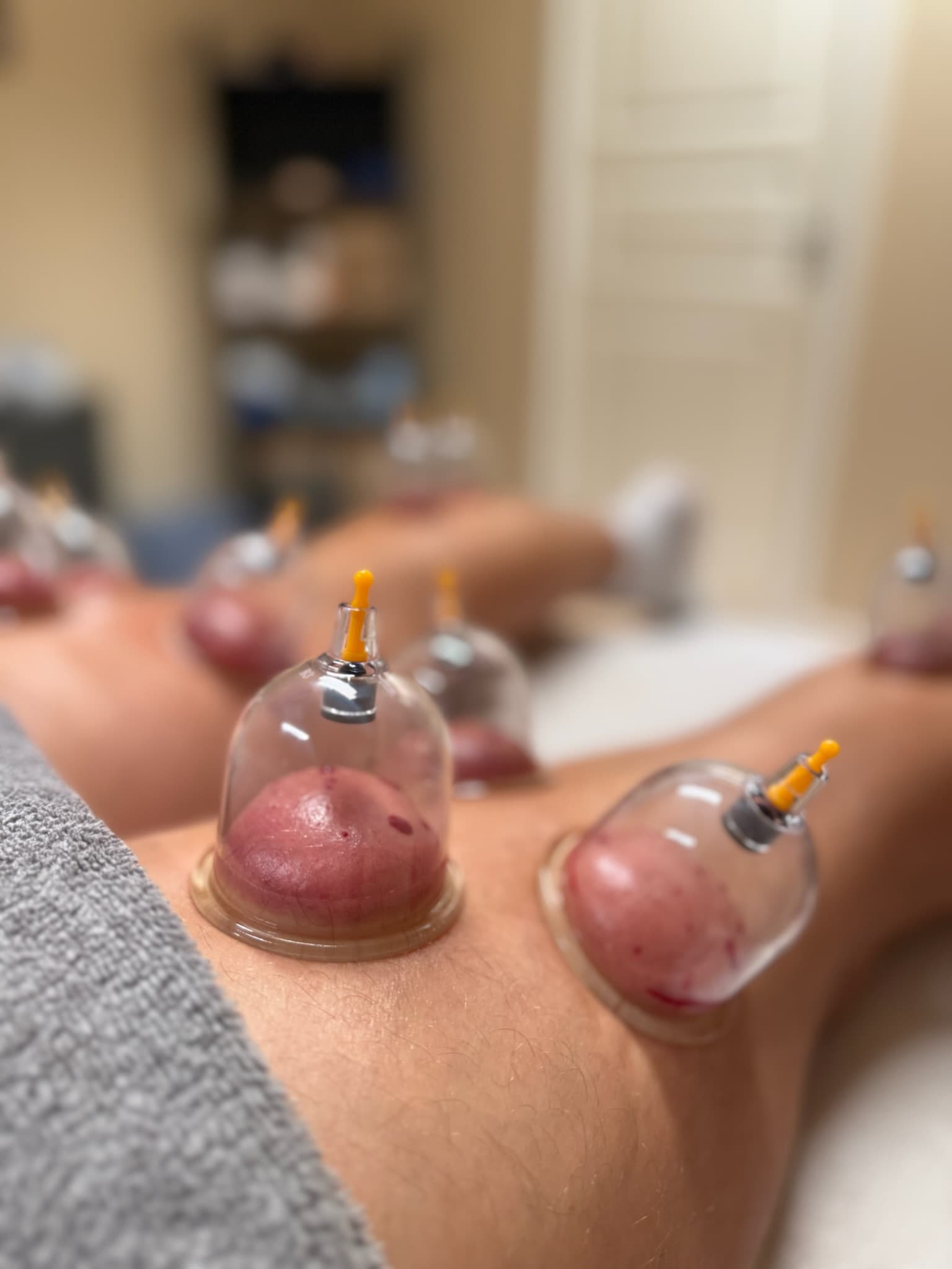 Hijama behandling på arm
