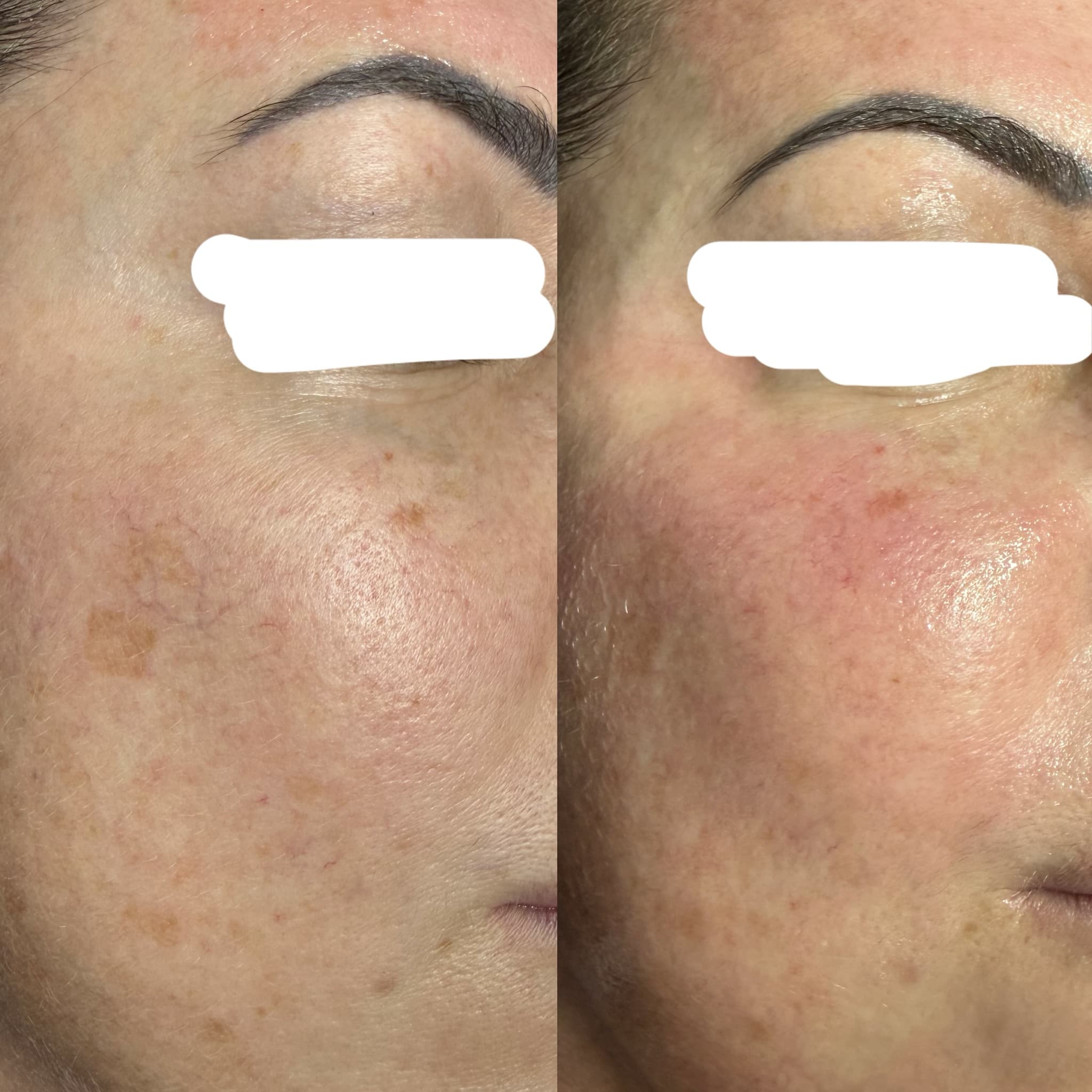 Før og efter microneedling — reducerede pigmentforandringer på kinden